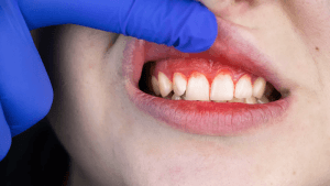 Clínica de Encías | Mal aliento e Implantes Dentales Lima — foto