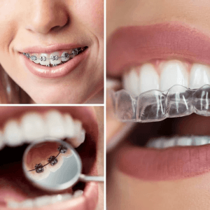 Clínica de Encías | Mal aliento e Implantes Dentales Lima — foto