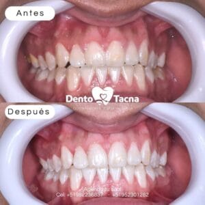 Clínica Dental Dento Tacna | Implantes dentales Tacna — foto