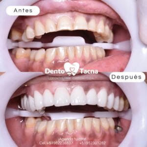 Clínica Dental Dento Tacna | Implantes dentales Tacna — foto
