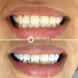 Impacto Dental Jesús María | Diseño de Sonrisa | Ortodoncia | Implantes | Alineadores — foto